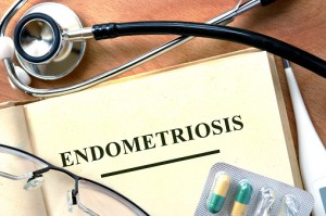 endometriosis-488786798