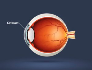High quality raster illustration of cataract (eye disease)