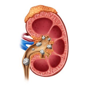 kidney stones 524903454