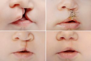 Baby with cleft before and after surgery