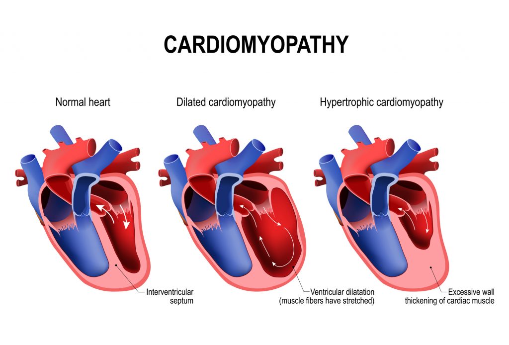 what-does-it-mean-to-have-an-enlarged-heart-health-beat