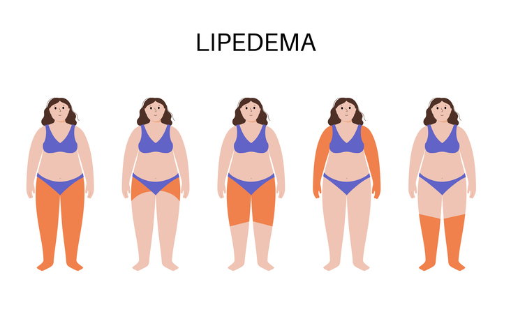 What is Lipedema? - Health Beat