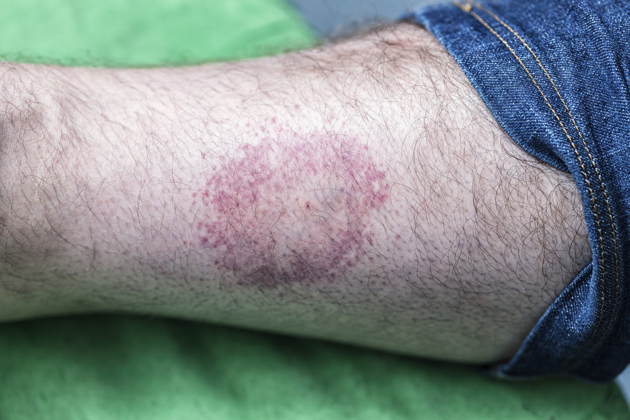 Signs and Symptoms of Untreated Lyme Disease - Health Beat
