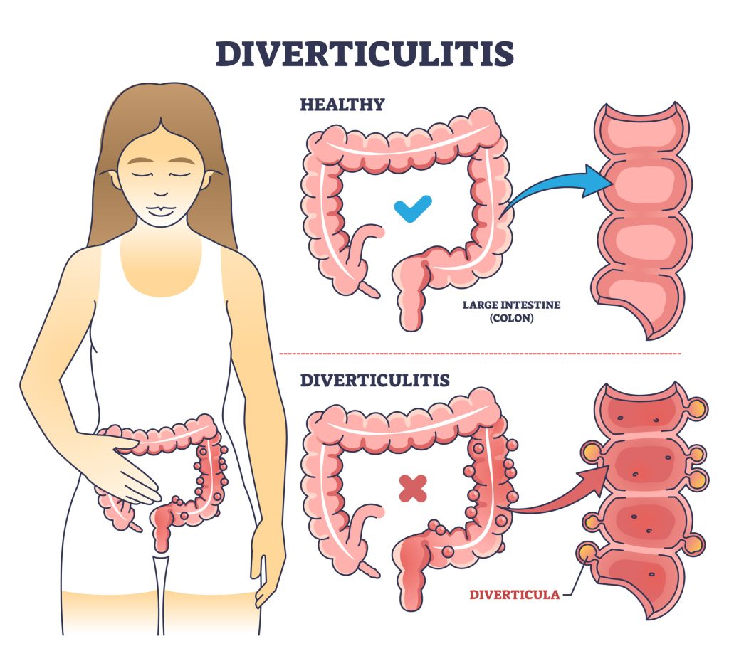 Diverticulitis - Health Beat